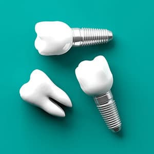 A illustration of what dental implants look like