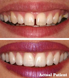 Smile Design Before and After