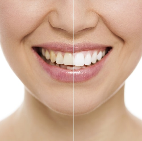 The before and after smile of a young woman who whitens her teeth with dental treatments from Tukwila, WA
