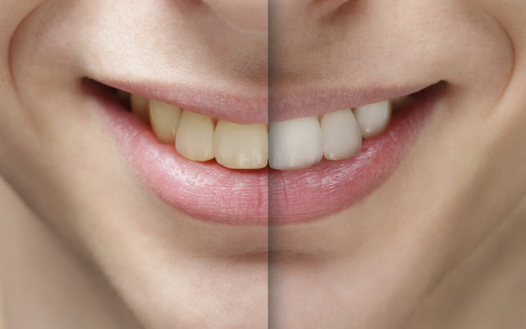 How Long Does In-Office Teeth Whitening Last? Unveiling the Secrets to a Radiant Smile