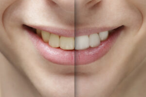 A split image shows before and after teeth whitening